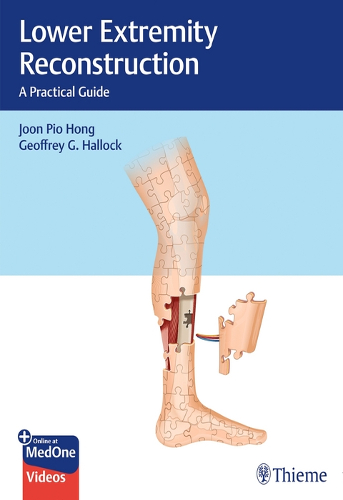 Lower Extremity Reconstruction : A Practical Guide | Uniandes